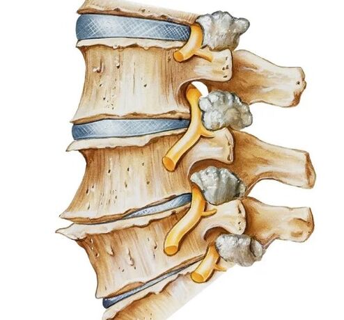 Pinching of the nerve in the back