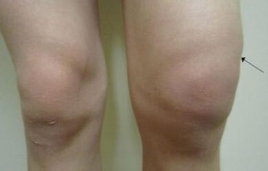 Clinical manifestations of knee joint arthrosis