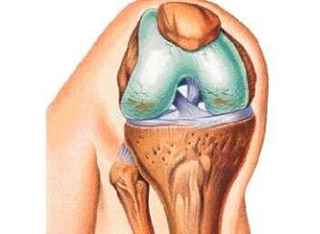 The main causes of knee arthrosis