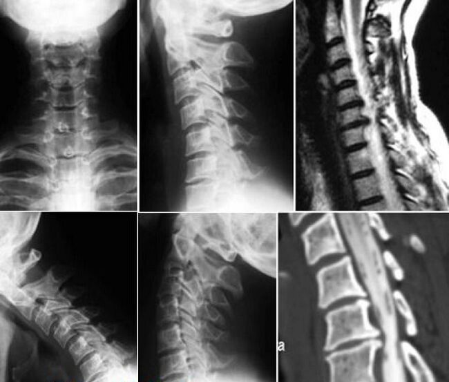 X-rays of the cervical spine for the diagnosis of osteochondrosis