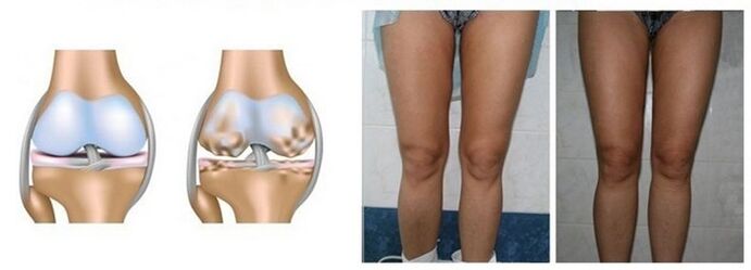 loss of osteoarthritis of the knee joint with osteoarthritis